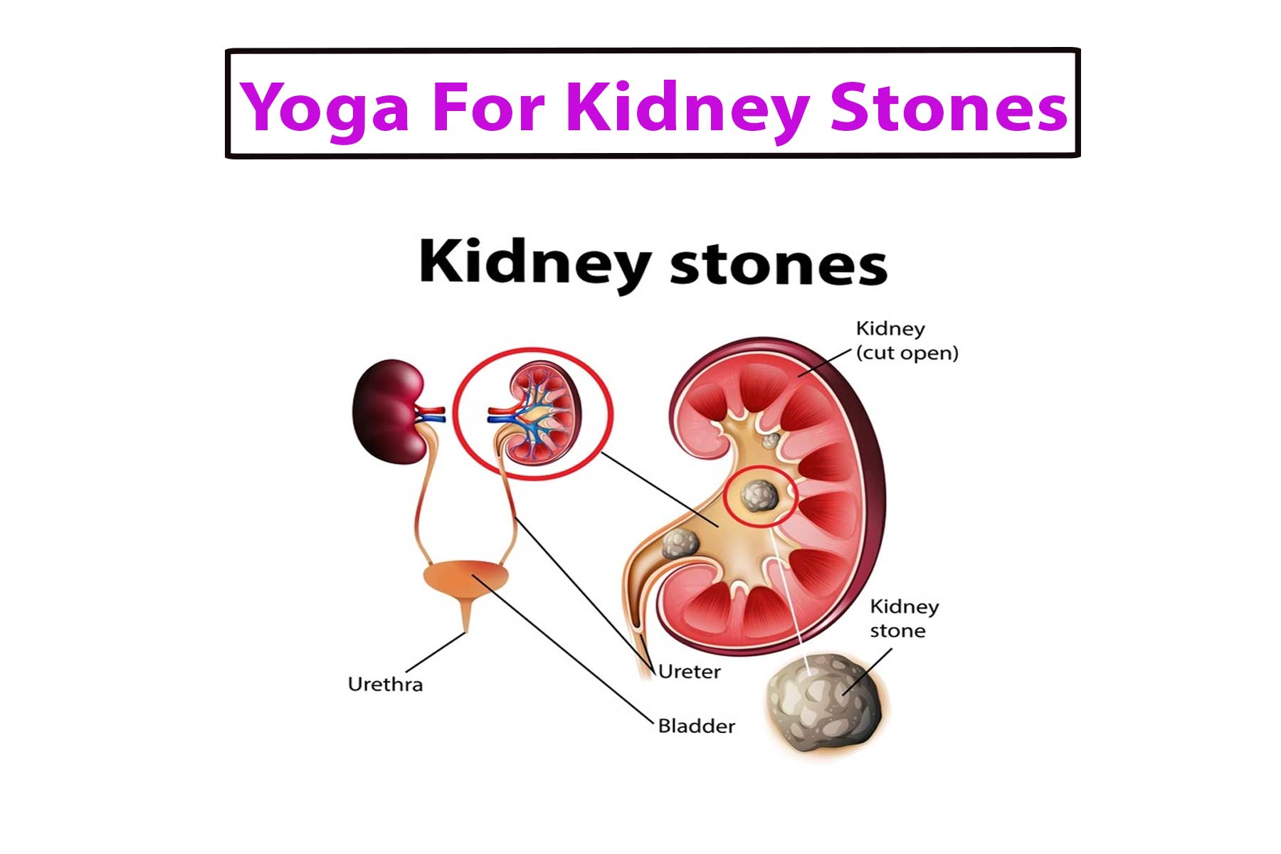 Kidney Stone Diet Plan and Prevention | Max Lab